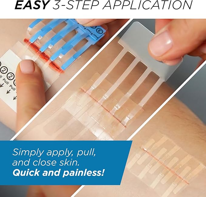 Clozex Emergency Laceration Kit - Repair Wounds Without Stitches, Skin Closure Device for a Wound Up to 1 1/2 Inches Length. Complete Kit to Clean, Close, & Cover Wounds