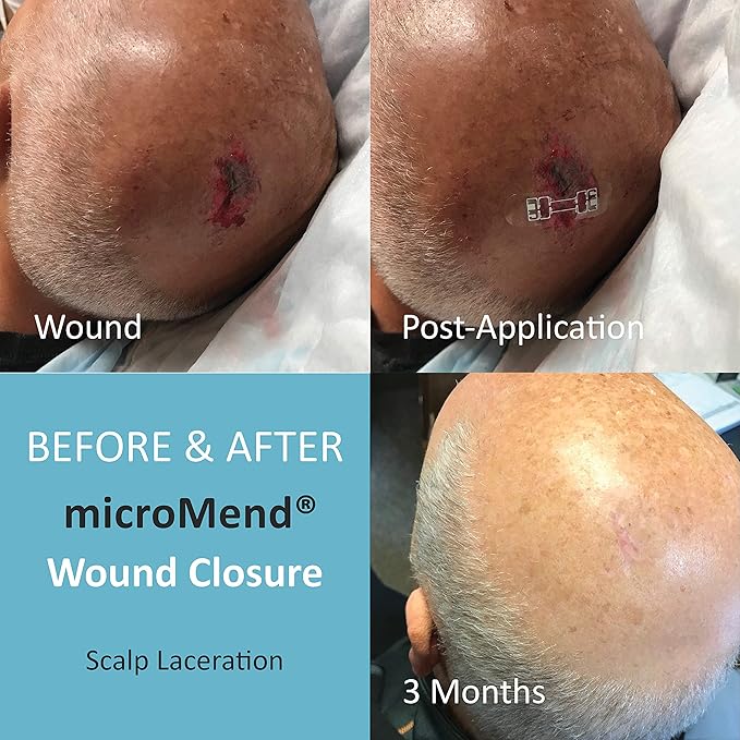 Emergency Wound Closures Surgical Quality Laceration Repair Without Stitches - Think Ahead - Be Prepared- (Emergency Wound Closures XS/SM (2 Devices - 1 Alcohol Prep Pad - 1 Gauze)