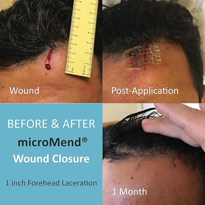 Emergency Wound Closures Surgical Quality Laceration Repair Without Stitches - Think Ahead - Be Prepared - Add to Your First Aid Kit, Camping Gear (Multi Pack - 3 Packs of 2 Medium Devices)